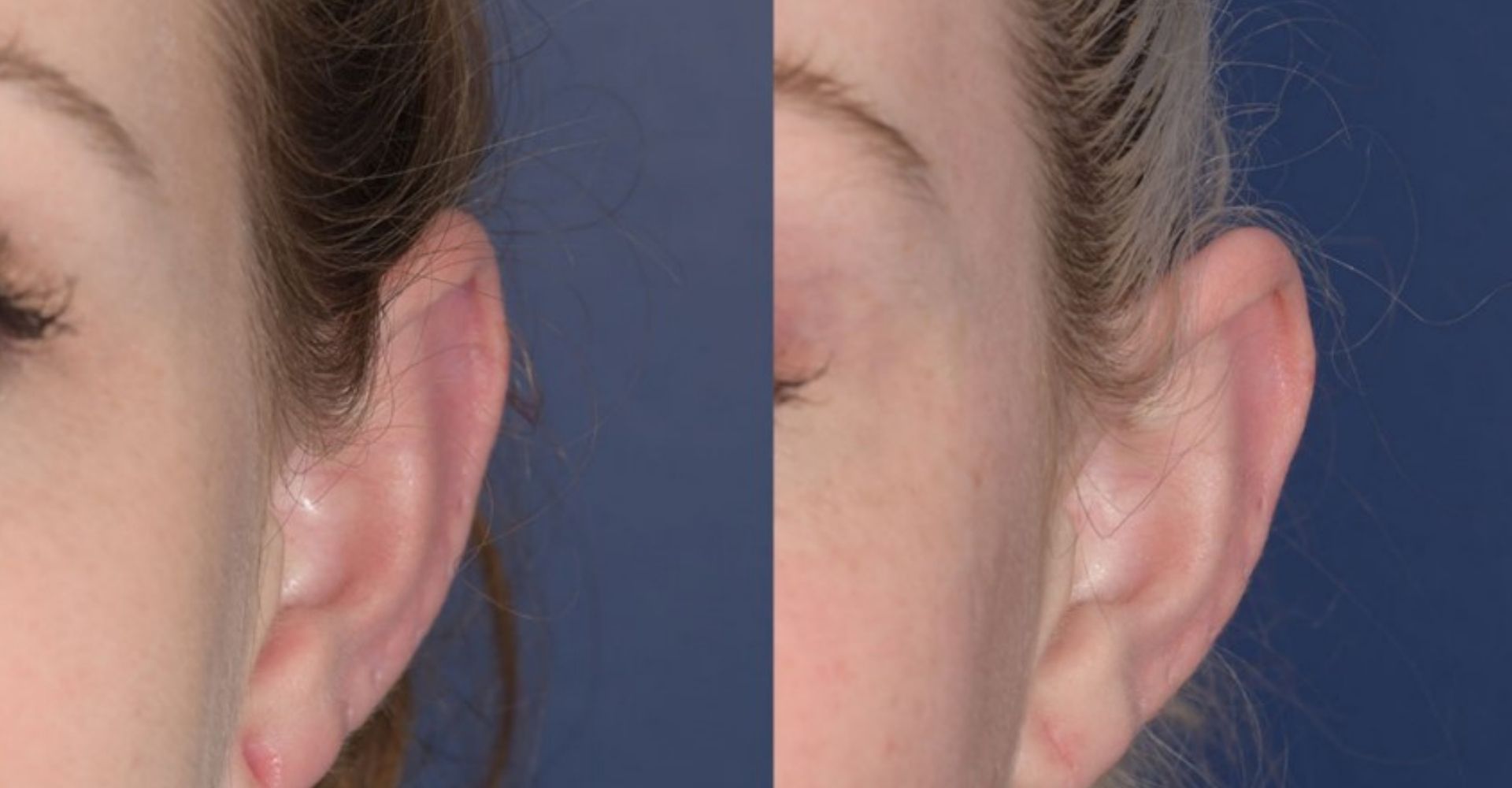 Best Cosmetic Ear Lobe Repair Treatment in Coimbatore