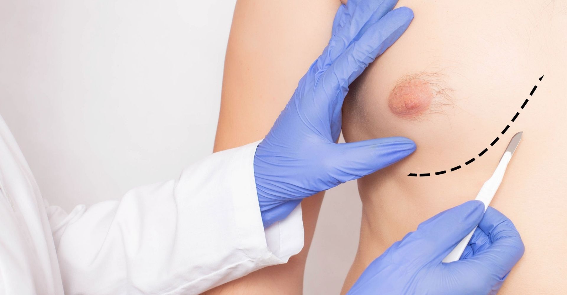Best Cosmetic Male Breast Surgery in Coimbatore